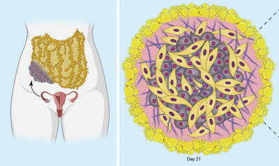 Ovarian cancer model published in iScience