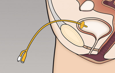 Suprapubic catheter