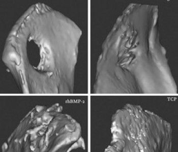 Bone formation around an implant