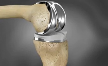 Knee replacement implant (https://bonesmart.org/knee/choosing-a-knee-implant-prosthesis/)
Image credit: Conformis