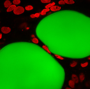 click/tap to enlarge this image... Adipo-mimetic biomaterials (organo-hydrogels) were used in our study to mimic adipose (fat) tissues and study the migration of ovarian cancers. The image shows ovarian cancer cells migrating and squeezing past two adipocytes.