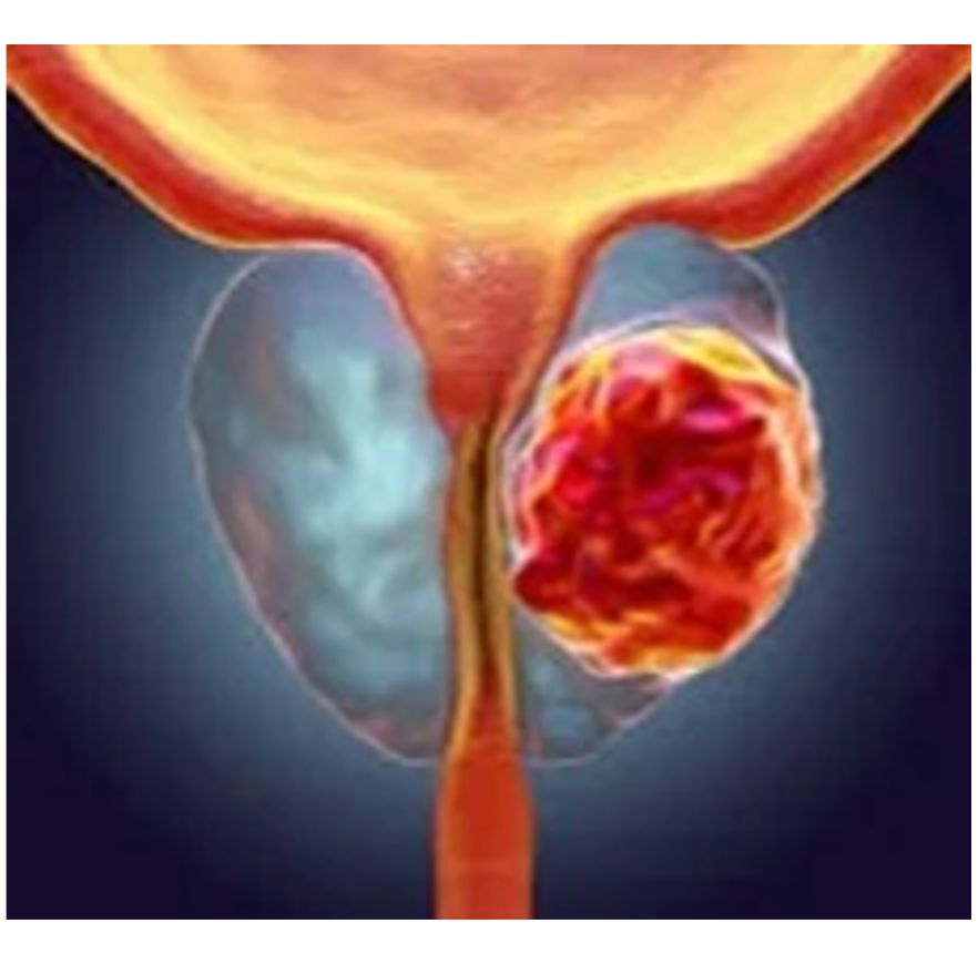 Prostate