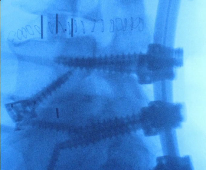 Image of bone graft substitute material, Actifuse, used in spinal surgery.
