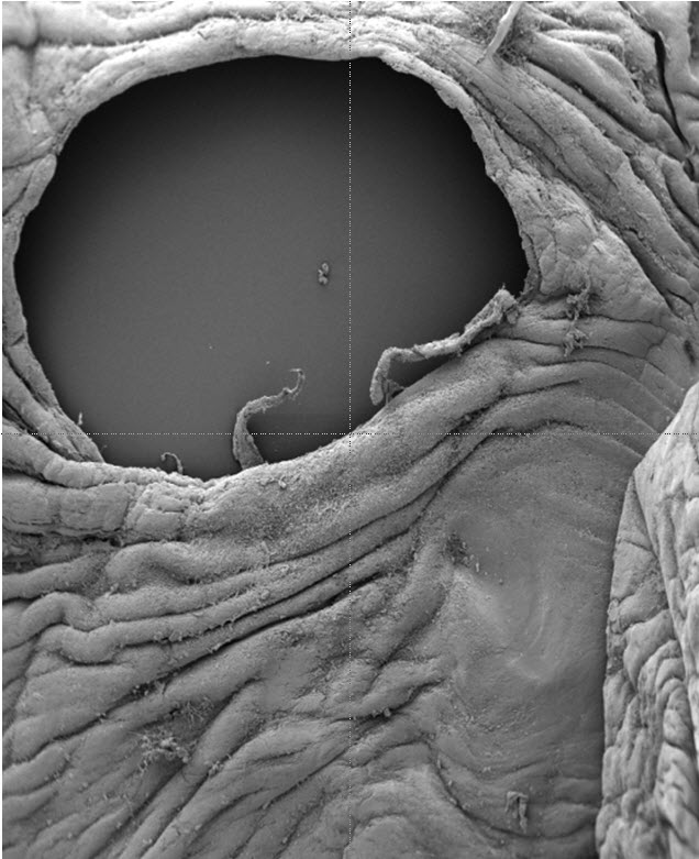 Hole found in the fetal membranes ten weeks after fetoscopic intervention. The surgeon created a hole through the fetal membranes to fix the problem with the baby&#39;s placenta. However, the hole never healed leading to premature rupture of the fetal membranes.