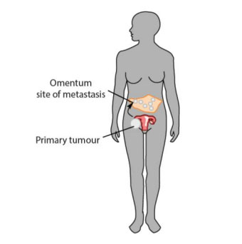 Diagram showing omental metastasis in high grade serous ovarian cancer