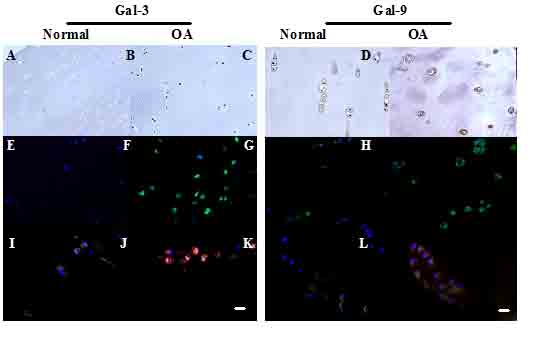 IMF shows strong abundance of Gal-3 (green; F) and Gal-9 expression (green; H) in human OA cartilage when compared to normal tissue (E, G). Co-localisation with lubricin (I, K) or CD44 (J, L) shows greater abundance of Gal-3 in superficial and deep zone cartilage. Gal-9 was strongly expressed by deep zone cells from older tissue (red, L). 