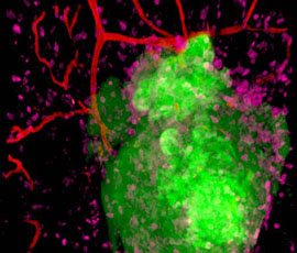 Mouse model of ovarian cancer showing cancer cells in green, immune cells in pink and blood vessels in red.